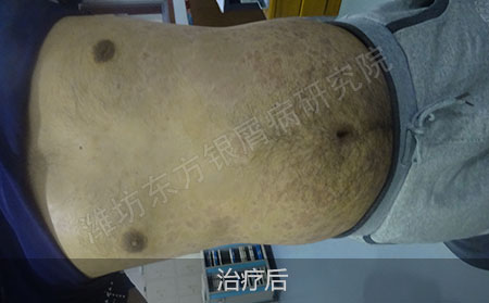银屑病治疗后怎么才能防止复发