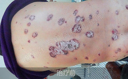 潍坊治疗银屑病效果好的医院在哪