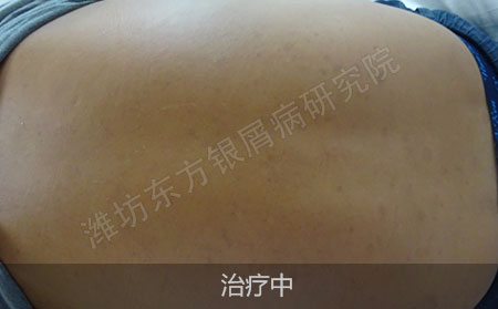 脓疱型银屑病怎么治疗效果好