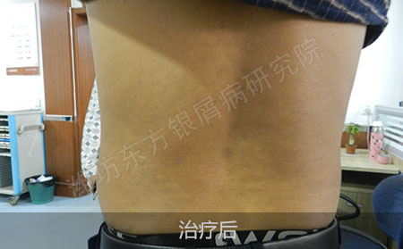 银屑病怎么治疗才能有效防止复发