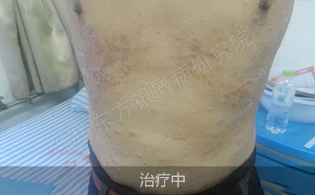 中药治疗银屑病效果怎么样