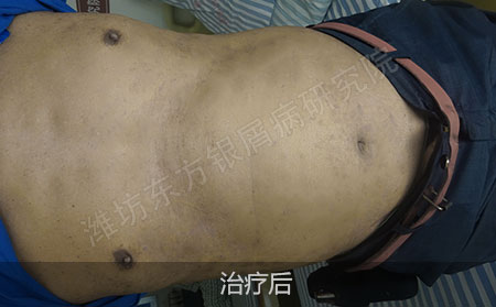 银屑病治疗怎么防止复发