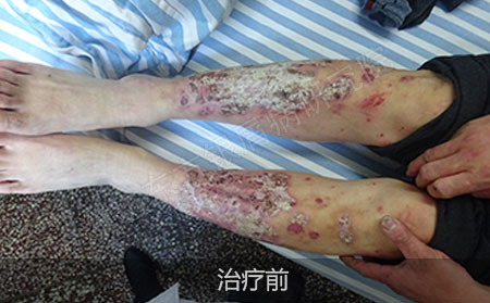 潍坊治疗银屑病医院哪家效果好