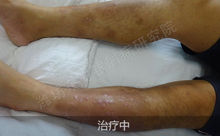 脓疱型银屑病怎么治疗才能恢复