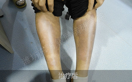 脓疱型银屑病恢复后怎么才可以治疗效果好