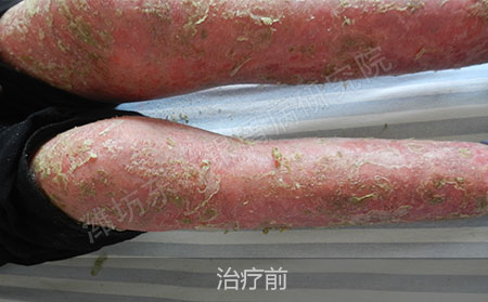 潍坊治疗银屑病哪家医院效果好