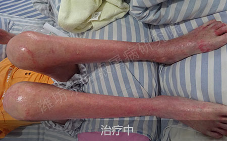 脓疱型银屑病要怎么治疗才有效