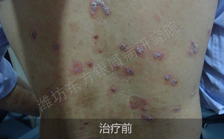 潍坊治疗银屑病医院哪家效果好
