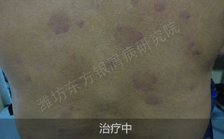 脓疱型银屑病要怎么治疗才能恢复