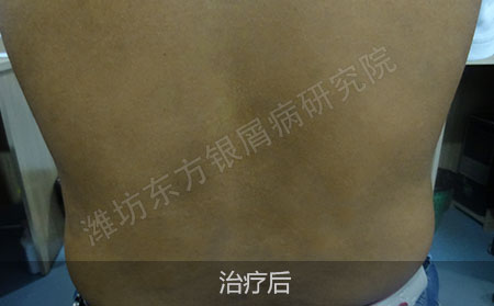 银屑病恢复后要怎么防止复发