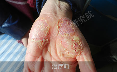 潍坊治疗银屑病医院哪家可以
