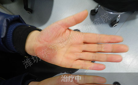 掌趾脓疱病怎么治疗才能恢复