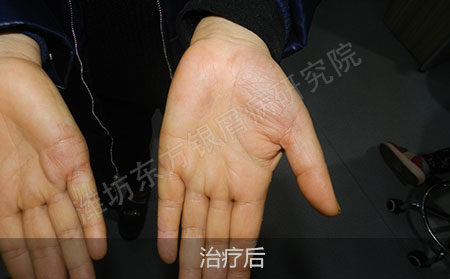 掌趾脓疱病治疗后怎么治疗效果好