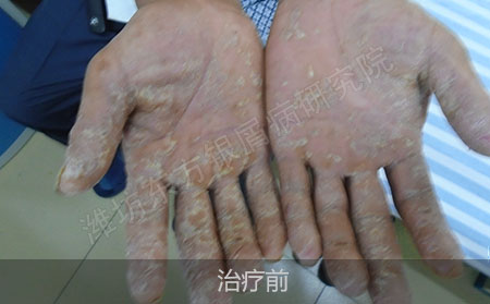 潍坊治疗掌趾脓疱病医院哪家可以