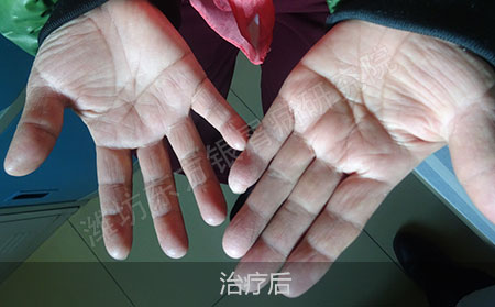 掌趾脓疱病怎么治疗才可以治疗效果好