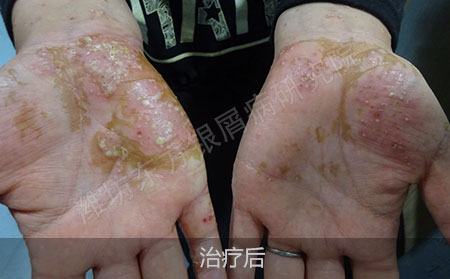潍坊治疗掌趾脓疱病医院哪家可以