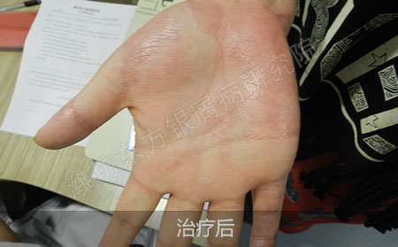 掌趾脓疱病要怎么治疗