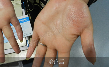 掌趾脓疱病治疗后怎么防止复发