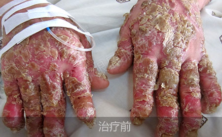 关节型银屑病潍坊哪家医院治疗效果好