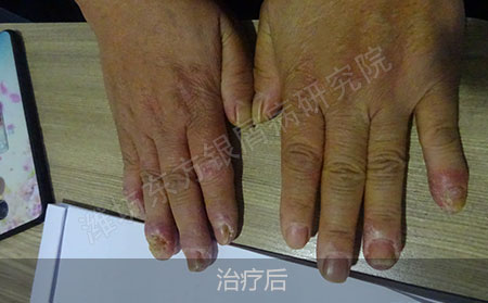 关节型银屑病怎么才能有效治疗