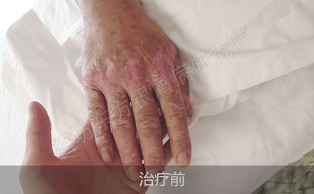 关节型银屑病潍坊哪家医院治疗效果好