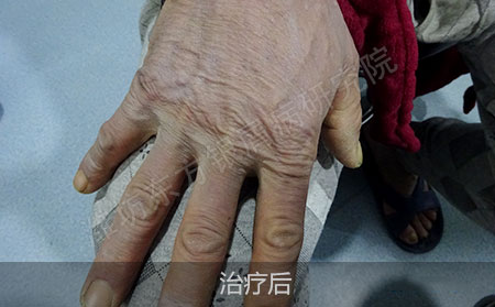 潍坊治疗银屑病怎么防止复发