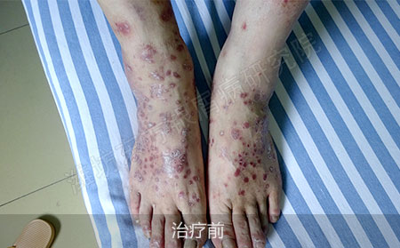 潍坊治疗掌趾脓疱病医院哪家可以