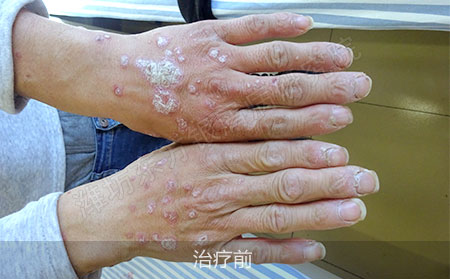 潍坊治疗掌趾脓疱病医院哪家效果好