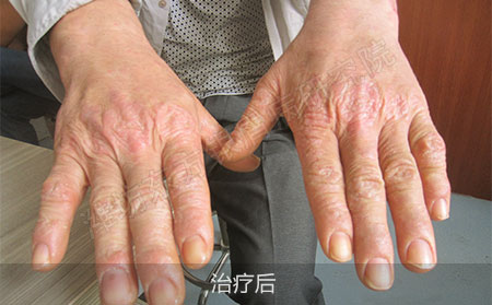 掌趾脓疱病治疗后怎么防止复发