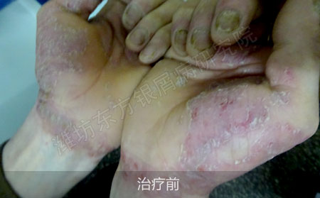 潍坊治疗掌趾脓疱病医院哪家效果好