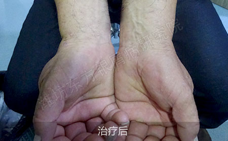 潍坊治疗银屑病怎么有效防止复发