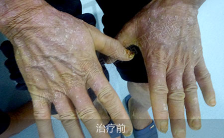 潍坊治疗掌趾脓疱病医院哪家效果好
