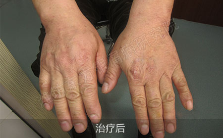 掌趾脓疱病治疗后怎么防止复发