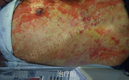 潍坊治疗银屑病医院哪家效果好