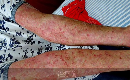 潍坊银屑病医院哪家治疗效果好