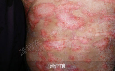 潍坊治疗银屑病医院哪家可以