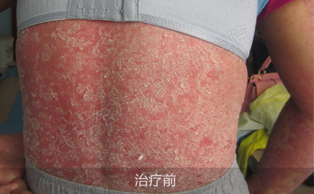 潍坊治疗银屑病医院哪家效果好