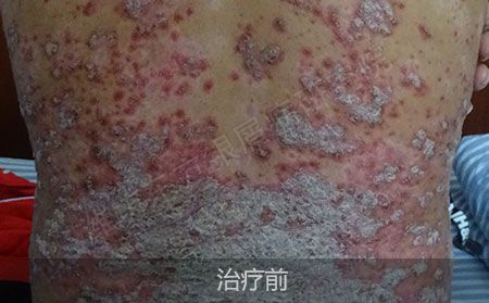 脓疱型银屑病要怎么治疗
