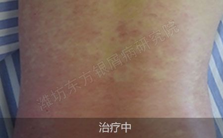 潍坊治疗银屑病医院哪家效果好