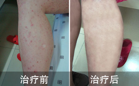 怎么治疗银屑病