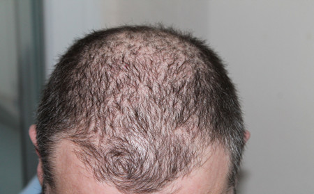减缓脱发的生活小方法 牛皮癣患者改善生活习惯开始
