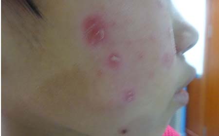 潍坊女性银屑病患者要慎用化妆品
