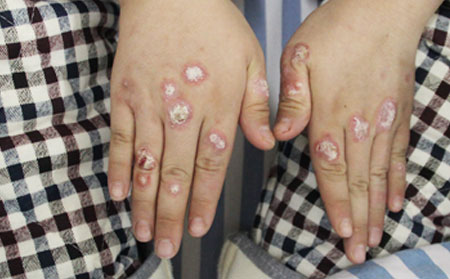 指甲型银屑病症状表现