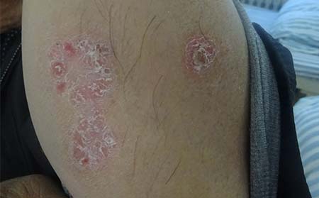 银屑病症状,身上得银屑病症状