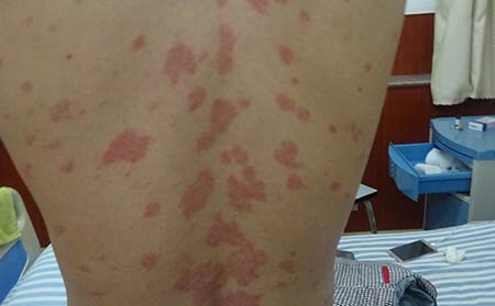 银屑病症状,银屑病症状特征