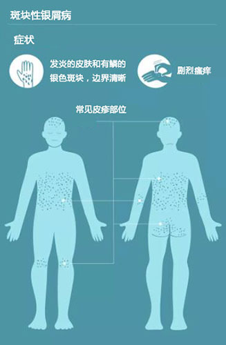 牛皮癣的发病原因治疗用什么药