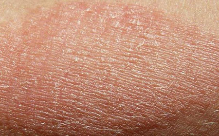 牛皮肤癣症状早期-皮肤干燥