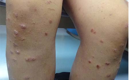 女性银屑病治疗,怎样治女性银屑病,潍坊东方银屑病研究院
