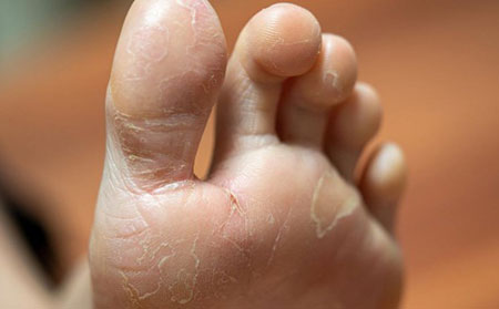脚足部掌跖牛皮癣银屑病图片症状