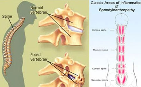 脊椎炎的图片症状